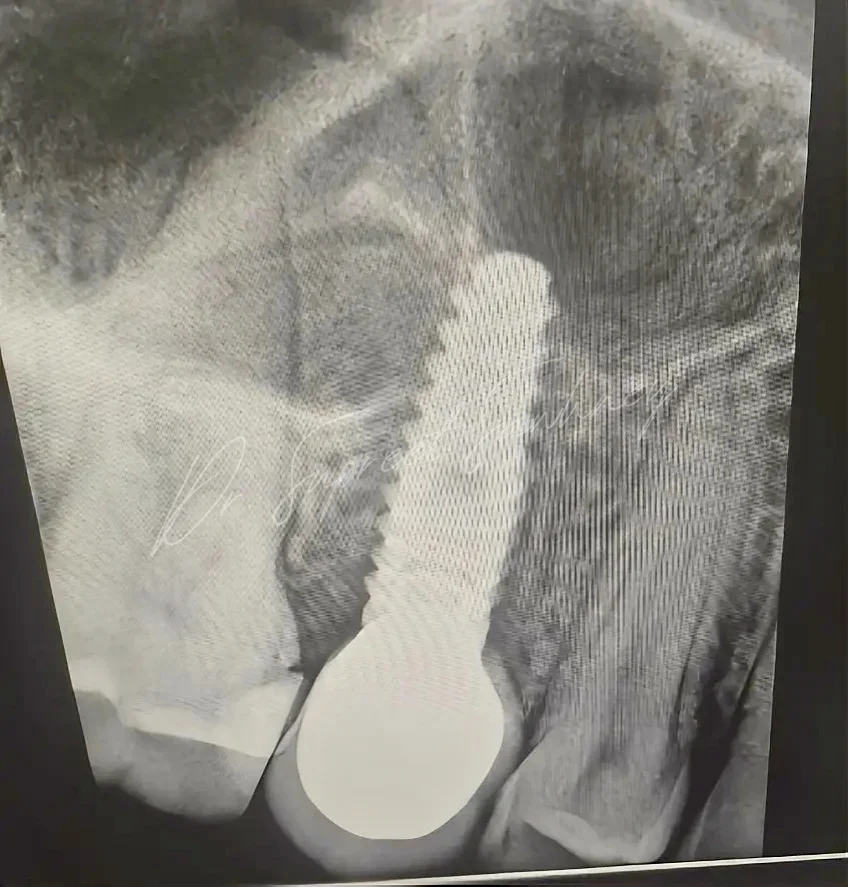 Periapical radiograph of a posterior maxillary implant supporting a single crown